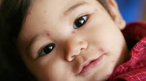 Để giúp phòng tránh căn bệnh này, các mẹ nên cho con đi tiêm phòng và cách ly người khỏe với người đang bị mắc bệnh trong gia đình. Khi trẻ đã bị nhiễm bệnh, bố mẹ nên chăm sóc trẻ đúng cách. Không dùng kháng sinh để điều trị bệnh dịch do virus vì kháng sinh không có tác dụng diệt virus.