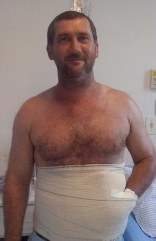 Anh Carlos Mariotti, 42 tuổi là công nhân sống ở bang Orleans ở phía Nam Brazil đã phải qua ca phẫu thuật kỳ lạ ghép tay vào bụng trong suốt sáu tuần.