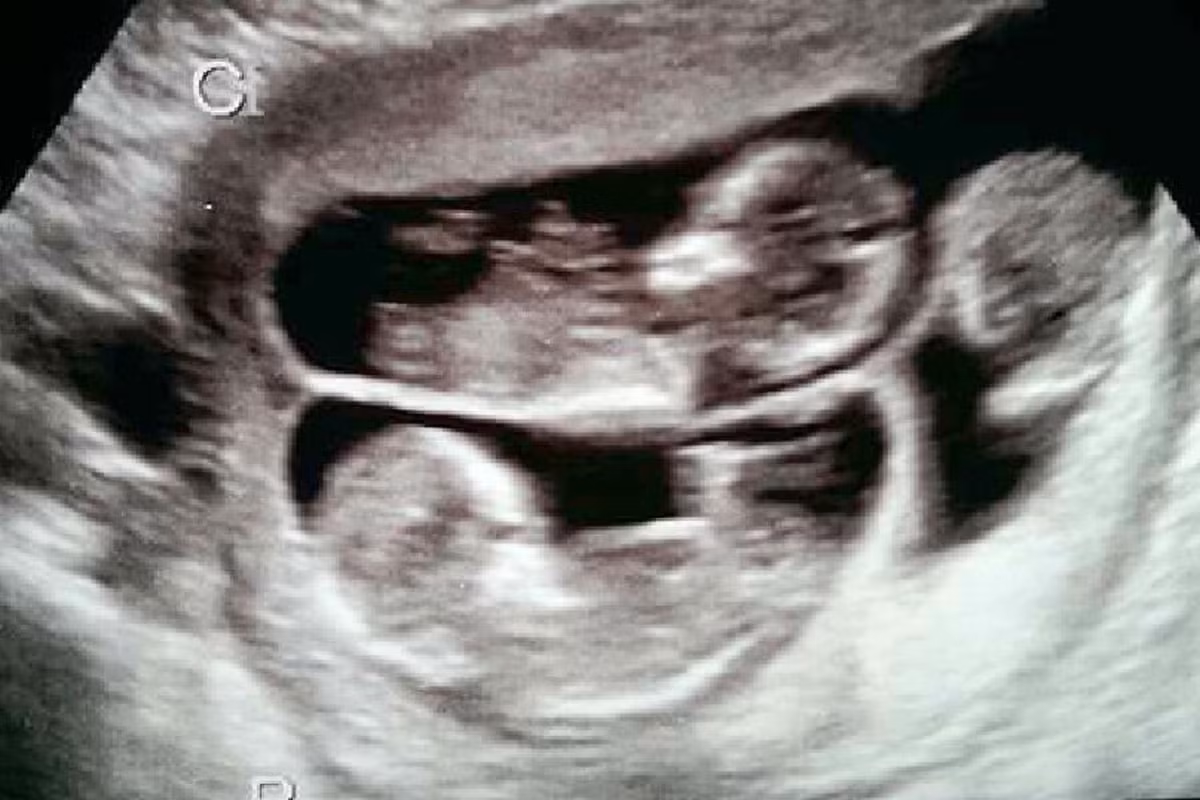 Khi siêu âm có 3 nhịp tim bà Sharon đã khóc vì vui sướng. Ngày 21 vừa qua, 3 em bé kháu khỉnh đã chào đời.