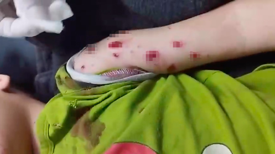 Be trai 4 tuoi bi da chan thuong do nhat “vat la” phat no