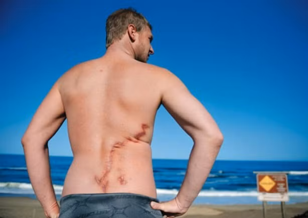 Todd Endris, một người lướt sóng ở California đã được cá heo cứu sống khi bị tấn công liên tiếp ba lần bởi một con cá mập trắng lớn. Khi thấy Todd vùng vẫy chống cự trong tuyệt vọng, một bầy cá heo đi ngang qua đã tiến đến giải cứu, bơi vòng xung quanh chàng trai, ngăn không cho cá mập trắng tiếp tục giết người. Todd sau khi được cứu sống đã vô cùng biết ơn bầy cá heo, anh thậm chí còn không thể tin mình còn sống.