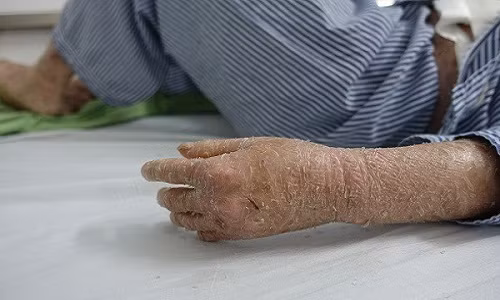 Kho so kinh hoang can benh “nguoi ran” o Viet Nam