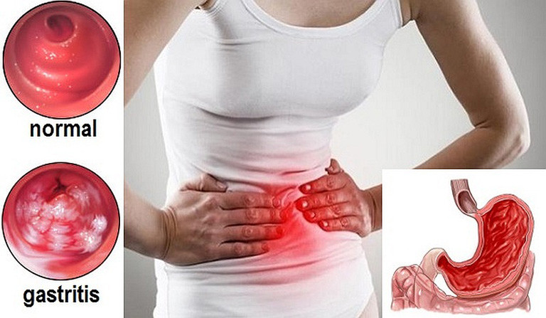 Đối với người bị xuất huyết dạ dày, việc tuân thủ các nguyên tắc và chế độ ăn uống hợp lý, lành mạnh, khoa học là điều tối quan trọng. Ảnh: thuocdantoc.