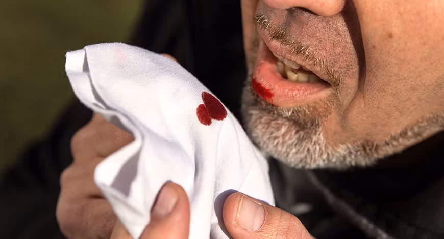 Các thức ăn giàu chất béo và gia vị cũng hạn chế ăn bởi chúng có khả năng tăng độ pH trong dạ dày, kích thích chức năng co bóp và tăng tiết dịch vị. Ảnh: đaudạdày.