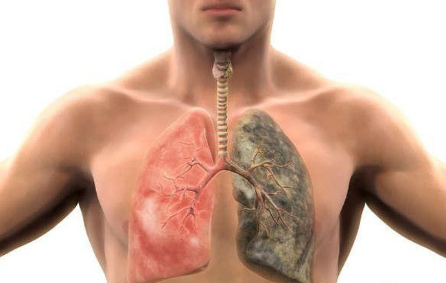 Một trong những cách hiệu quả để làm sạch phổi tự nhiên đó chính là liệu pháp hơi nước. Ảnh: sohacdn.