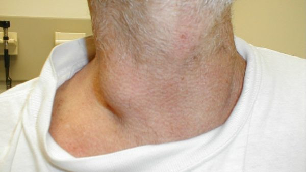 Thiếu máu là một trong những tiêu chí để chẩn đoán bệnh ung thư hạch trên lâm sàng có đang tiến triển nhanh hay không, tình trạng thiếu máu ít hay nhiều và tỷ lệ đông máu nhanh hay chậm là cơ sở xác định bệnh. Ảnh: fucomin.