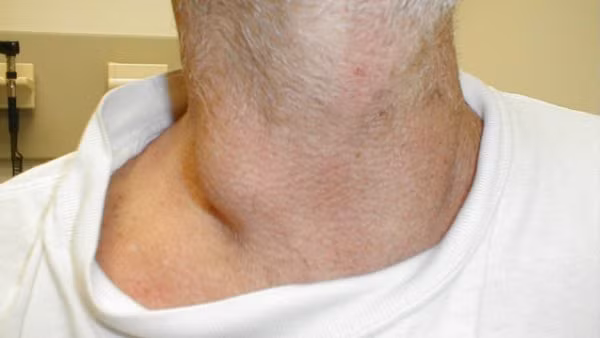 Thiếu máu là một trong những tiêu chí để chẩn đoán bệnh ung thư hạch trên lâm sàng có đang tiến triển nhanh hay không, tình trạng thiếu máu ít hay nhiều và tỷ lệ đông máu nhanh hay chậm là cơ sở xác định bệnh. Ảnh: fucomin.