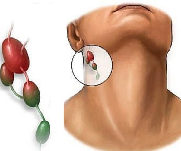 Suy giảm miễn dịch cũng là dấu hiệu và là tình trạng của hầu hết bệnh nhân ung thư hạch. Ảnh: benhvienungbuouhungviet.