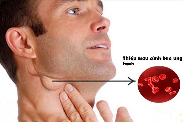 Các hạch bạch huyết phát triển dần dần, từ kích thước bằng hạt đậu nành cho đến kích thước của quả táo tàu. Có những bệnh nhân khối u có đường kính lên đến hơn 20 cm. Ảnh: ksol.