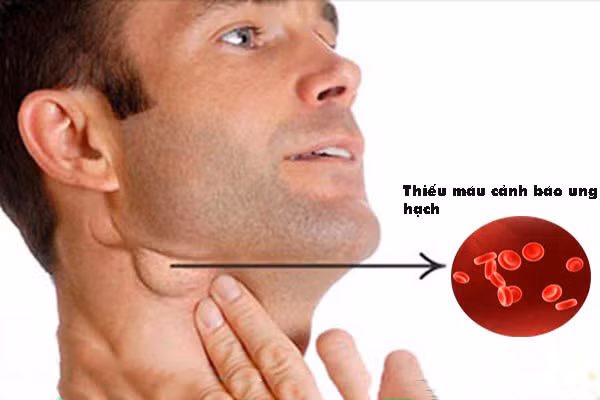 Các hạch bạch huyết phát triển dần dần, từ kích thước bằng hạt đậu nành cho đến kích thước của quả táo tàu. Có những bệnh nhân khối u có đường kính lên đến hơn 20 cm. Ảnh: ksol.