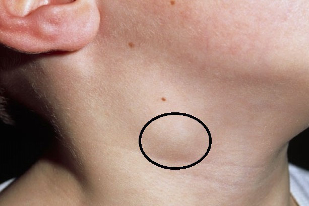 Ở giai đoạn sớm, hầu hết bệnh nhân không có cảm giác đau. Cảm giác đau xuất hiện khi bệnh ở giai đoạn tiến triển. Ảnh: giadinh.