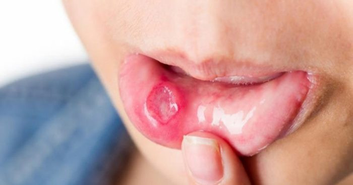 Xuất hiện khối u ở vùng môi hoặc trong toàn bộ khoang miệng, cổ họng cũng là một dấu hiệu của ung thư môi bạn cần lưu ý. Ảnh: dkn.