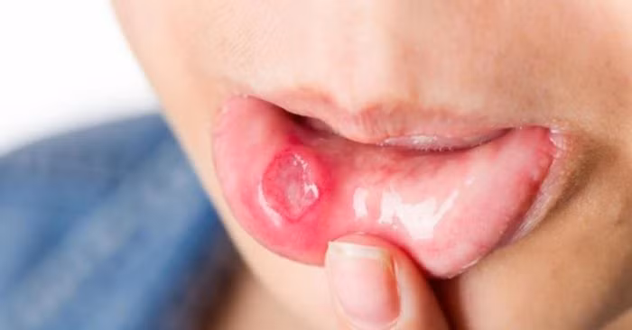 Xuất hiện khối u ở vùng môi hoặc trong toàn bộ khoang miệng, cổ họng cũng là một dấu hiệu của ung thư môi bạn cần lưu ý. Ảnh: dkn.