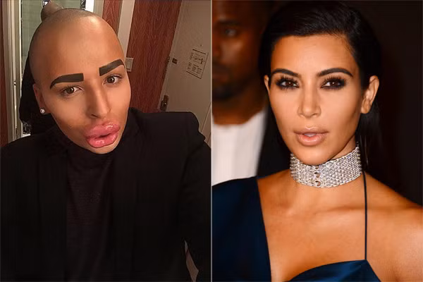 Jordan James Parke (trái) sau khi phẫu thuật để giống thần tượng Kim Kardashian.