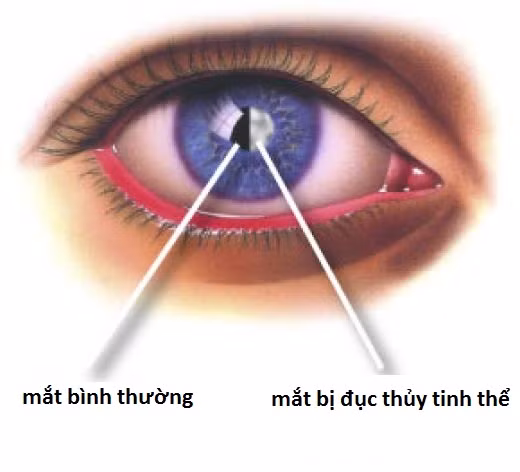 Đục thể thuỷ tinh cũng là bệnh mắt thường gặp và khiến thị lực mắt bị giảm dần. Nếu bạn bị đục thủy tinh thể thì hay mắt thường mờ dần, thị lực giảm đi mà không hề có biểu hiện đỏ hay đau nhức mắt. Bệnh có thể chữa bằng cách mổ mắt hoặc thay thế thủy tinh thể nhân tạo.