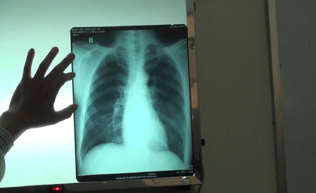 Tim kiem cong nghe AI ho tro doc X-quang nguc cho tram y te-Hinh-2