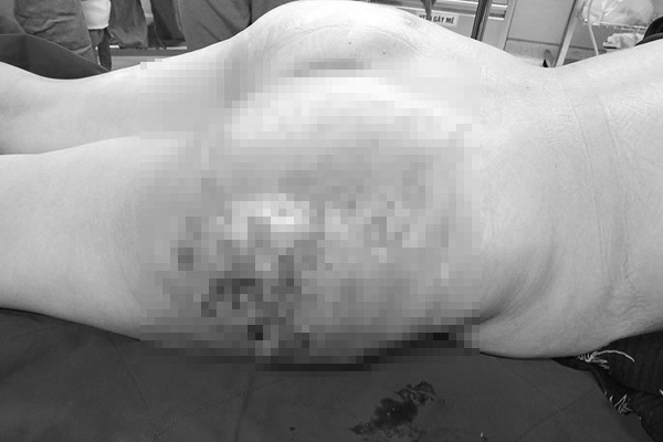 Bệnh nhân được phẫu thuật, nạo vét ra khoảng 2,5 lít tổ chức hoại tử và dịch mủ.