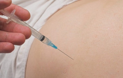 Bệnh nhân vào viện cấp cứu trong tình trạng vùng hoại tử đã lan rộng, nằm rải rác. Sau một tuần tiêm kháng sinh, vùng hoại tử gom lại thành một ổ lớn, bác sĩ hút ra khoảng 200 ml dịch mủ.