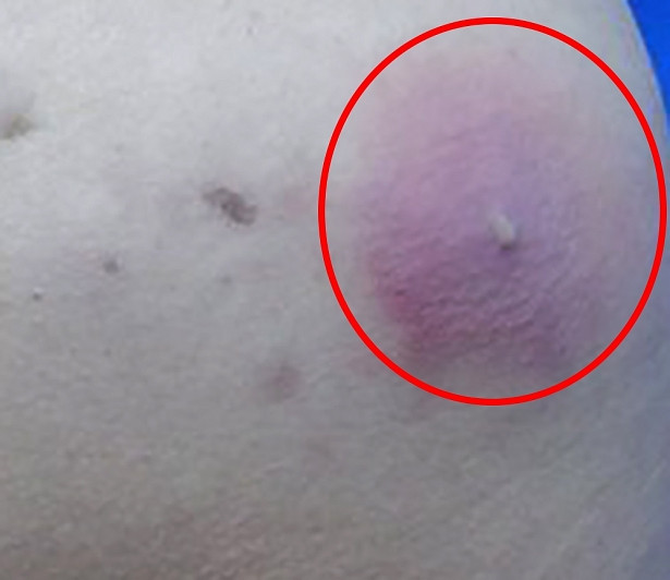 Bác sĩ Nguyễn Đình Minh, Trưởng khoa Phẫu thuật tạo hình thẩm mỹ và hàm mặt cho biết, bệnh nhân nhập viện trong tình trạng có 2 khối áp xe đang nhiễm trùng, sưng, tấy đỏ ở mông. Qua kết quả khám, chụp cộng hưởng từ, các bác sĩ thấy 2 khối dịch lớn có tính chất trong suốt, kèm theo rất nhiều hạt nhỏ rải rác khắp 2 bên mông bệnh nhân.