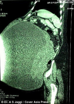 Soc: Khoi u buong trung 97kg khoi co the benh nhan-Hinh-2