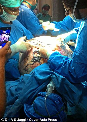 Soc: Khoi u buong trung 97kg khoi co the benh nhan-Hinh-3