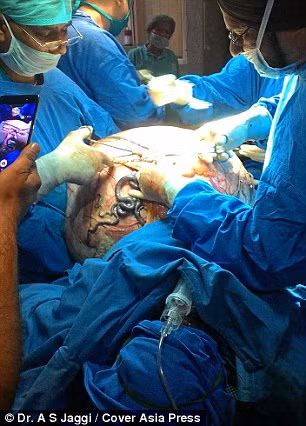 Soc: Khoi u buong trung 97kg khoi co the benh nhan-Hinh-3