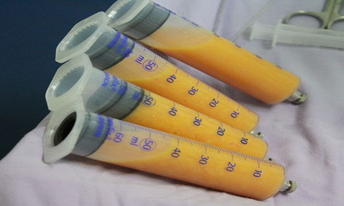 Nâng ngực bằng mỡ tự thân nghĩa là sử dụng mỡ thừa ở những phần khác trên cơ thể bạn như bụng, mông hoặc đùi… để cấy vào vùng ngực cải thiện kích thước vòng ngực. Ảnh: Benhvienthammy.