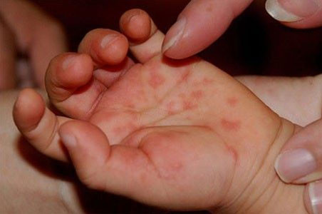 Độ 3 - 4 là tình trạng bệnh nặng và rất nặng cần được điều trị hồi sức cấp cứu tích cực tại bệnh viện. Trẻ bị chân tay miệng độ 3 thường có biểu hiện mạch nhanh trên 170 lần/phút, cao huyết áp, thở nhanh, thở bất thường, rối loạn tri giác, tăng trương lực cơ. Ảnh: Nihe.