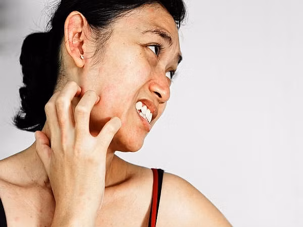 Người bị dị ứng cũng là nhóm người phải tránh xa quả đu đủ ngay cả khi loại quả này đã chín vàng. Theo một số nghiên cứu thì vỏ quả đu đủ có chứa nhiều nhựa rất dễ tác động tới những người có cơ địa nhạy cảm, dễ dị ứng. Ảnh: Kênh sức khỏe.