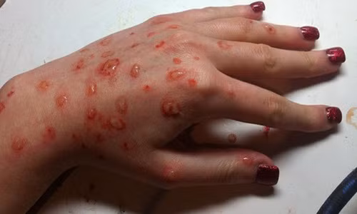 Bệnh thủy đậu là một bệnh cấp tính do nhiễm virus Varicella Zoter gây ra. Bệnh này thường lây lan mạnh vào đầu mùa hè. Thời điểm hiện tại, bệnh thủy đậu ở Hà Nội đang diễn biến khá phức tạp, với rất nhiều ca mắc. Trong đó, có một số bệnh nhân bị biến chứng nặng do thủy đậu phải nhập viện cấp cứu. Ảnh: Việt báo.