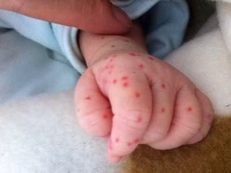 Sốt xuất huyết cũng dễ bùng phát trong mùa hè vì đây là mùa muỗi sinh sôi nhanh và truyền bệnh mạnh hơn. Sốt xuất huyết không có vắc xin phòng bệnh vì thế bạn phải thường xuyên vệ sinh nhà cửa, diệt muỗi, ngủ màn để phòng muỗi đốt. Ảnh: Kiến Thức.