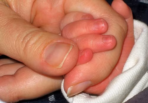 Bệnh chân tay miệng cũng là căn bệnh dịch dễ lây lan trong mùa hè. Bệnh này có thể tự khỏi tuy nhiên nó cũng có những biến chứng vô cùng nguy hiểm. Trẻ bị biến chứng khi mắc chân tay miệng thường diễn biến xấu rất nhanh và có nguy cơ tử vong cao. Ảnh: Kiến thức Việt.