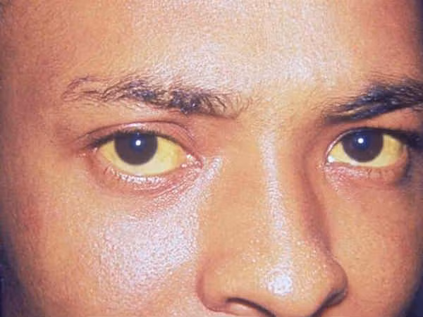 Vàng da vì tăng bilirubin trong máu do gan không bài tiết chất độc này ra ngoài.