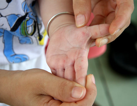 Với những bệnh nhân nặng độ 4 thường có biểu hiện bị sốc, phù phổi cấp, tím tái, ngưng thở, thở nấc. Đây là mức độ rất nguy hiểm, có nguy cơ tử vong rất cao. Ảnh: Hellobacsi.