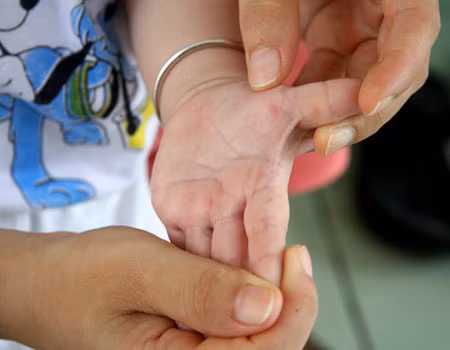 Với những bệnh nhân nặng độ 4 thường có biểu hiện bị sốc, phù phổi cấp, tím tái, ngưng thở, thở nấc. Đây là mức độ rất nguy hiểm, có nguy cơ tử vong rất cao. Ảnh: Hellobacsi.