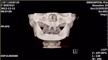 Nguyên nhân chiếc răng ma cà rồng mọc trong miệng cậu bé này chính là do mắc phải một căn bệnh lạ hiếm gặp.