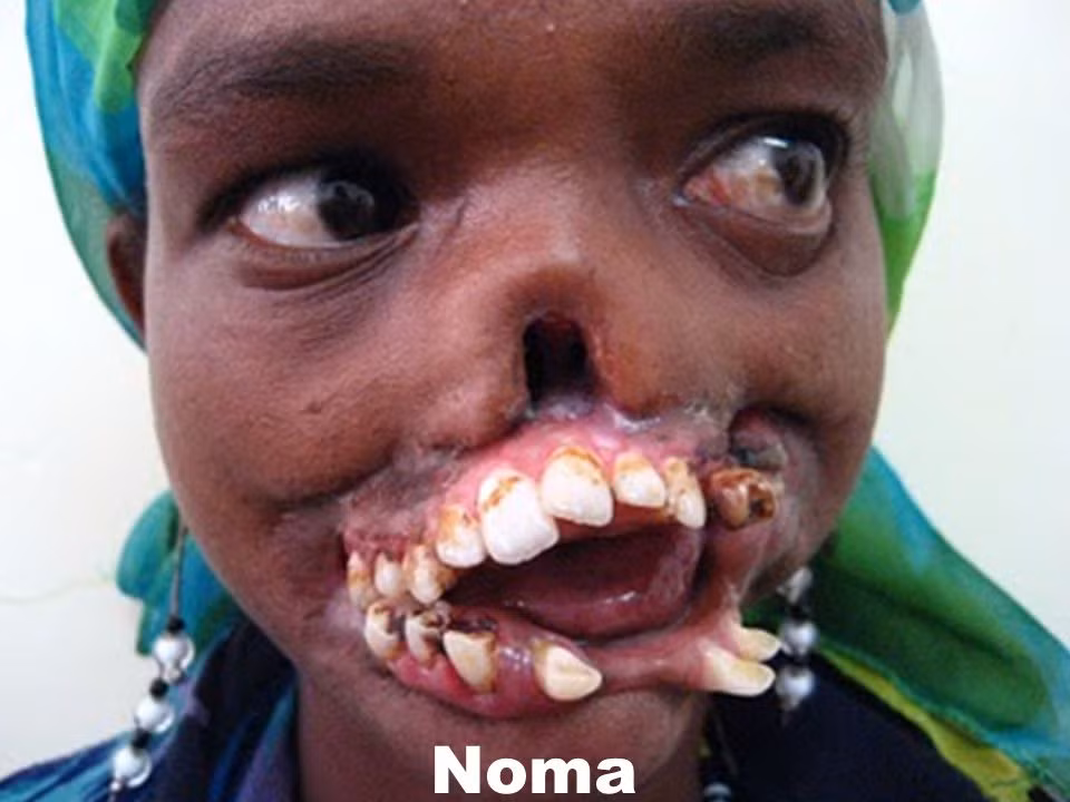 Cô bé có răng mọc chờm ra ngoài như răng sói: Thông tin về bệnh nhi này được một số tạp chí y khoa nước ngoài đăng tải. Cô bé người châu Phi này bị biến dạng vùng miệng khiến răng mọc chờm ra ngoài như người sói là nạn nhân của bị viêm miệng hoại tử do vi khuẩn ăn thịt người gặm nhấm. Ảnh: Noma.