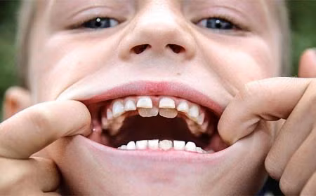 Cậu bé 8 tuổi người Anh mọc 2 hàm răng dị thường như răng cá mập vì những chiếc răng sữa mọc lên không hề rụng đi mà tồn tại song song với những chiếc răng vĩnh viễn mới mọc lên. Ảnh: Dailymail.