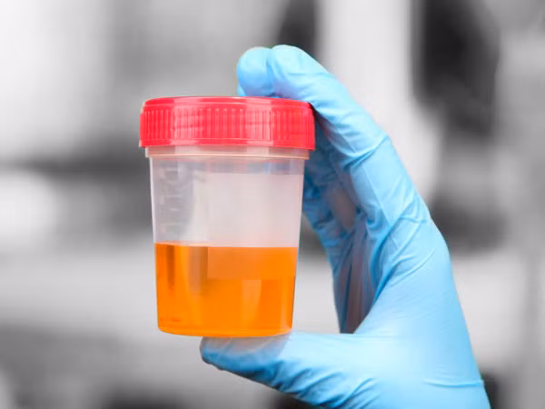 Nước tiểu biến đổi và màu sắc, mùi nước tiểu bất thường, nước tiểu xuất hiện nhiều bọt hoặc có màu cũng là dấu hiệu bệnh ung thư dễ bị quên lãng và nhầm tưởng sang bệnh khác.