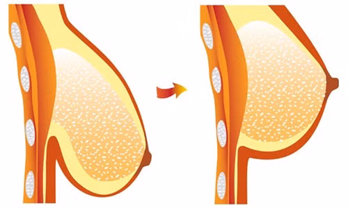  Ngực chảy xệ đến rốn là "thảm họa" mà nhiều chị em gặp phải sau khi sinh con, và tuổi ngày càng cao. 