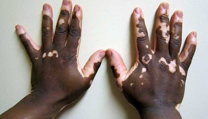 Bệnh Vitiligo đây là một bệnh sinh ra do sự mất sắc tố da trên cơ thể. Khi nhiễm bệnh, các tế bào sắc tố trên da bị chết đi khiến cho da người bị mất màu sắc đặc trưng và biến dạng hoàn toàn. Ảnh: Sống khỏe.
