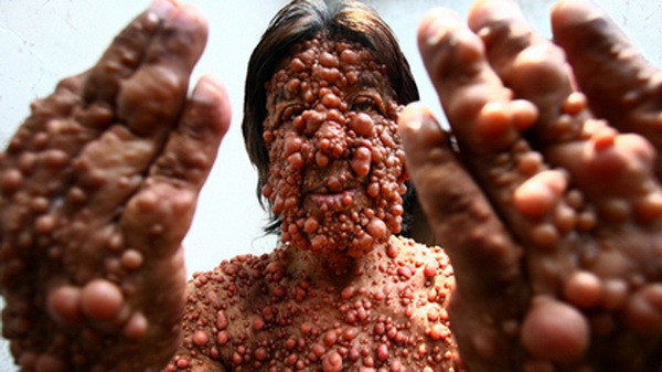 Bệnh bong bóng: Căn bệnh này là một dạng bệnh ngoài da hiếm gặp, người bị bệnh sẽ có hàng nghìn mụn bọng nước, mụn thịt mọc chi chít trên cơ thể. Số lượng bóng nước này thường tăng dần số lượng theo thời gian. Ảnh: Boldsky.