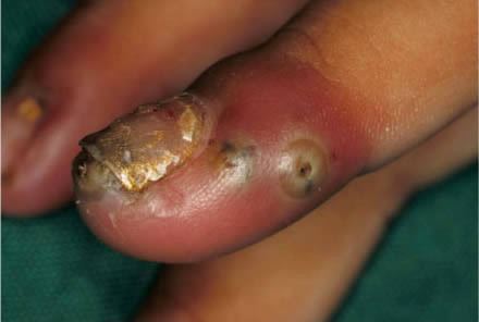 Khi nhiễm bệnh những con bọ chét sẽ đào hang trên da người và đẻ trứng trên đó khiến vùng cơ thể biến dạng rất khủng khiếp. Ảnh: VTC.