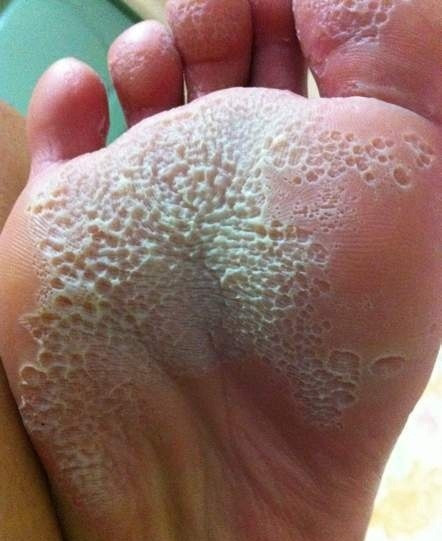 Tungiasis là bệnh mà da bị tàn phá bởi 1 loại bọ chét tên là Tunga. Ảnh: Bam.