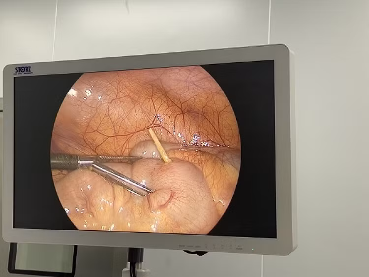 Phat hien xuong ga dai 4cm khi phau thuat viem ruot thua cho be 7 tuoi