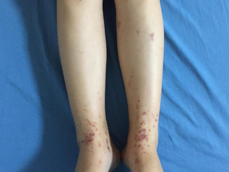 Tuong bi muoi dot, di kham moi ta hoa phat hien benh nguy hiem