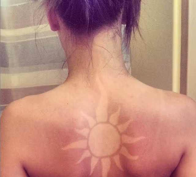 Hình xăm cháy nắng trông đẹp và lạ nhưng lại tiềm ẩn nguy cơ bệnh tật vô cùng lớn.