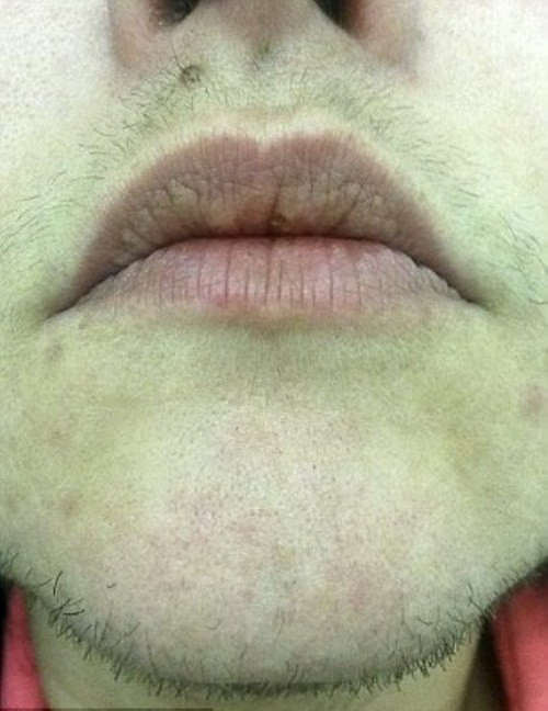 Trước đó, cô đã mất 6 năm điều trị hội chứng buồng trứng đa nang tại các trung tâm y tế. Cô tiêu tốn 2.000 bảng mỗi năm tiền mua dao cạo để cạo râu ba lần mỗi ngày. Tuy nhiên, tình trạng râu mọc nhanh vẫn không hề suy giảm.