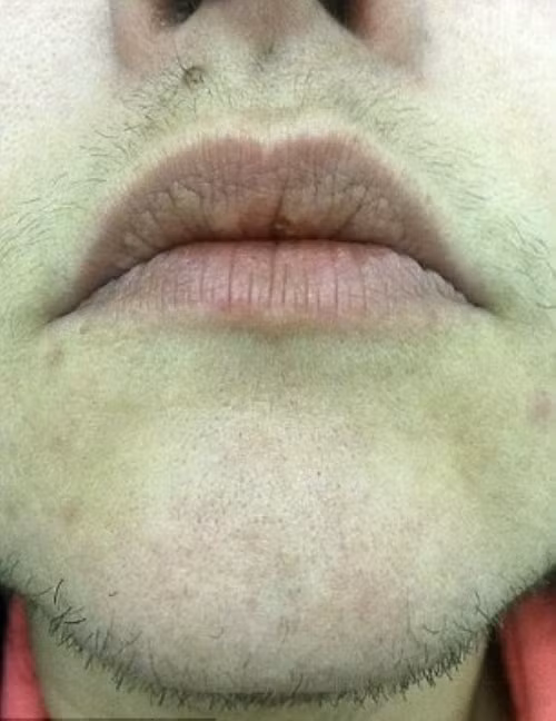 Trước đó, cô đã mất 6 năm điều trị hội chứng buồng trứng đa nang tại các trung tâm y tế. Cô tiêu tốn 2.000 bảng mỗi năm tiền mua dao cạo để cạo râu ba lần mỗi ngày. Tuy nhiên, tình trạng râu mọc nhanh vẫn không hề suy giảm.