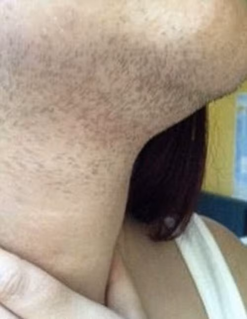 Chính vì thế, Howe quyết định đi triệt lông bằng laser với chi phí tối thiểu lên tới 10.000 bảng.